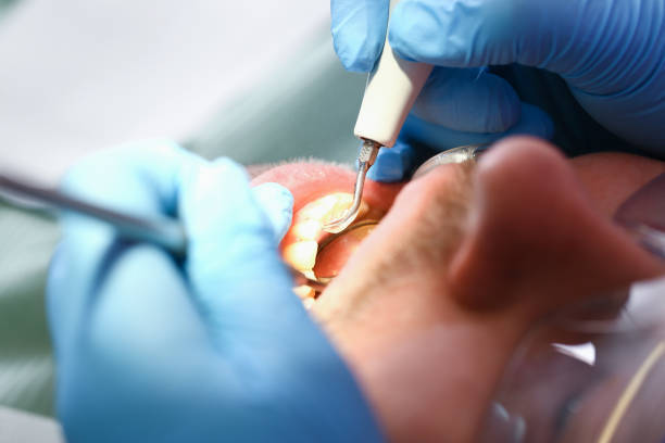 Best Emergency Dental Care for Abscessed Tooth in Montpelier, IN